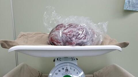 Cẩn trọng với căn bệnh 'cực lành tính' ở dạ dày nhưng để muộn thành ung thư