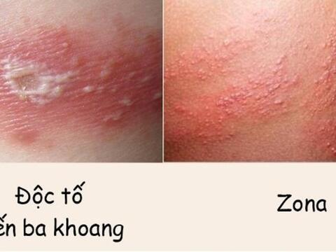 Phân biệt vết đốt của kiến ba khoang và zona thần kinh