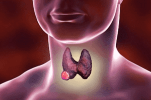 4 loại đồ ăn, thức uống nuôi lớn khối u tuyến giáp