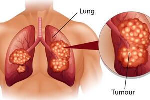 5 loại ung thư nguy hiểm có tính di truyền, nhà có người mắc thì con cái cần đi khám sàng lọc sớm