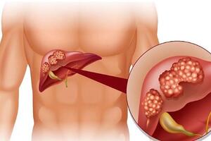 4 hiểu lầm về bệnh viêm gan B