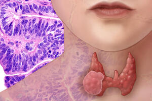 U tuyến giáp trẻ em ít gặp nhưng tỉ lệ ung thư cao