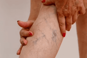 4 dấu hiệu cảnh báo cục máu đông trong cơ thể