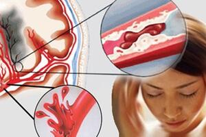 Những dấu hiệu cảnh báo mạch máu bị tắc nghẽn