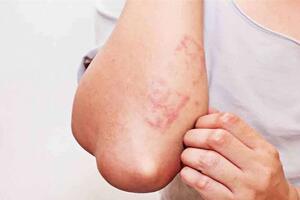 5 dấu hiệu cảnh báo bạn nhiễm giun sán