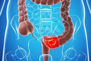 Dấu hiệu khi đại tiện có thể báo hiệu ung thư trực tràng