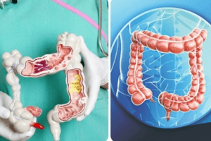 7 dấu hiệu ung thư đại tràng giai đoạn đầu dễ nhận biết