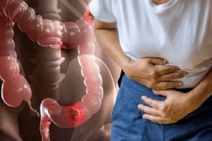 Ung thư ruột giai đoạn đầu thường có 3 tín hiệu dễ nhầm lẫn