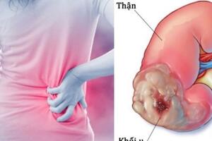 5 dấu hiệu cảnh báo ung thư thận không nên bỏ qua