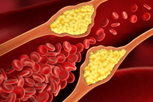 Bài tập đơn giản tại nhà giúp hạ huyết áp, "quét sạch" mỡ máu, phòng đột quỵ