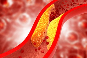Khi cholesterol ‘xâm chiếm’ động mạch, chân có thể phát ra dấu hiệu này