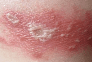 Người dân Hà Nội khốn khổ bị kiến ba khoang tấn công