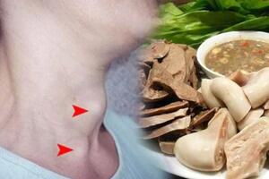 Người bị ung thư tuyến giáp không nên ăn gì để bệnh không chuyển nặng?