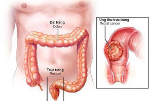 Chuyên gia dinh dưỡng ung thư tiết lộ 2 món ăn sáng giúp ngăn ngừa ung thư đại trực tràng