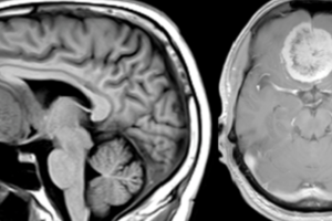 Đau đầu hầu hết là lành tính, nhưng nếu đi kèm 10 yếu tố này thì cần đi khám ngay