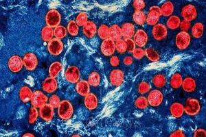 Ethiopia báo cáo ca bệnh đậu mùa khỉ đầu tiên