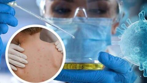 Dịch đậu mùa khỉ phức tạp, Việt Nam giám sát người đến từ 12 quốc gia lưu hành ca bệnh