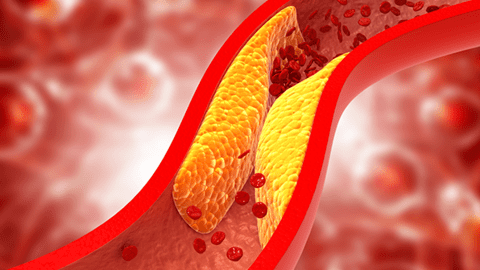 Khi cholesterol ‘xâm chiếm’ động mạch, chân có thể phát ra dấu hiệu này