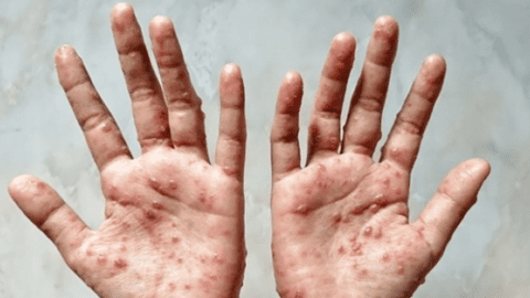 Việt Nam xuất hiện 2 ca đậu mùa khỉ chưa rõ nguồn lây, làm 6 điều để phòng bệnh