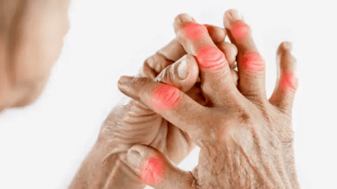 Khớp ngón tay bị sưng đau không chỉ do viêm khớp