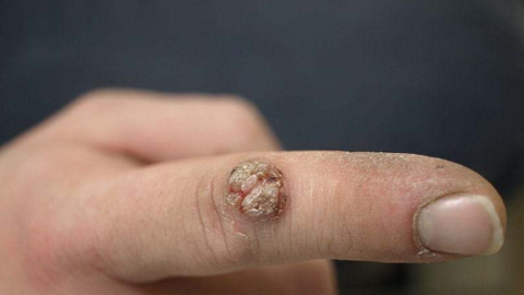 Nhiều người không dám dùng WC công cộng vì sợ bệnh lây qua đường tình dục: Bác sĩ nói gì?