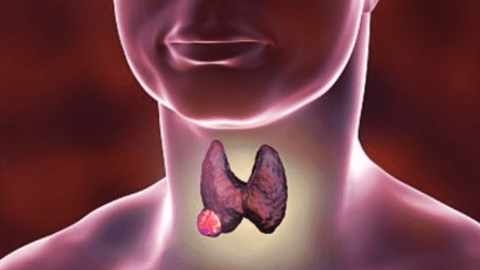 4 loại đồ ăn, thức uống nuôi lớn khối u tuyến giáp