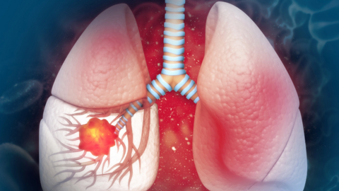 Triệu chứng ở vai cảnh báo căn bệnh ung thư nguy hiểm bậc nhất