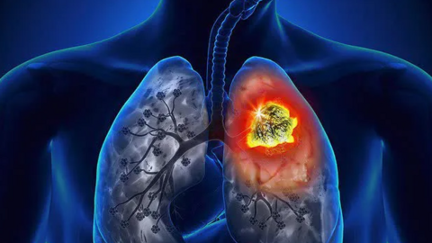 Ung thư phổi đang “rình rập” bạn nếu thức dậy buổi sáng thấy có dấu hiệu này