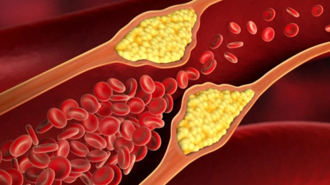 Bài tập đơn giản tại nhà giúp hạ huyết áp, "quét sạch" mỡ máu, phòng đột quỵ