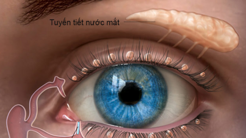 Sau khi bóc giả mạc có tái lại không? Giải thích từ bác sĩ Bệnh viện Mắt Hà Nội 2