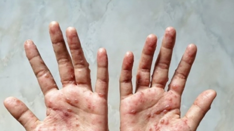 Việt Nam xuất hiện 2 ca đậu mùa khỉ chưa rõ nguồn lây, làm 6 điều để phòng bệnh
