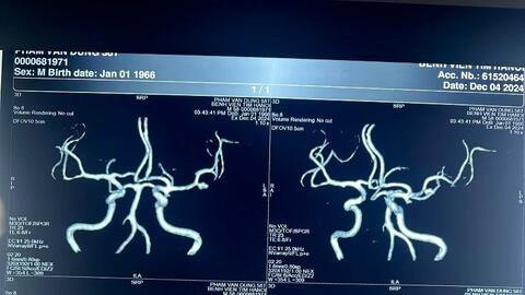 Phình mạch máu não - bệnh lý nguy hiểm