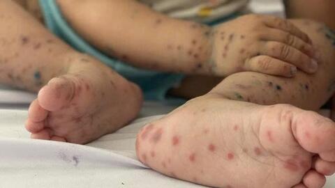 Chặn đường lây bệnh tay chân miệng