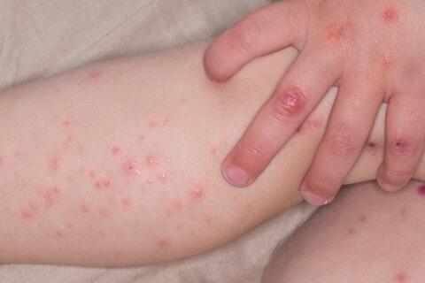 Số ca mắc tay chân miệng tiếp tục tăng