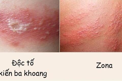 Phân biệt vết đốt của kiến ba khoang và zona thần kinh