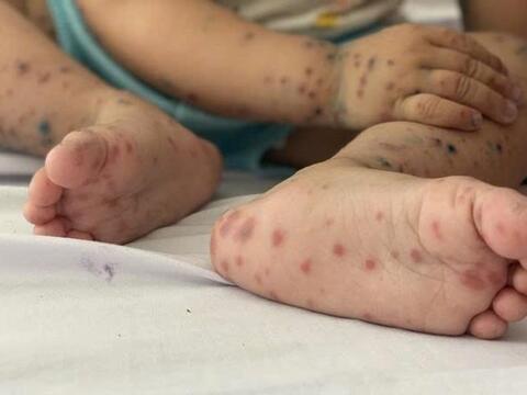 Chặn đường lây bệnh tay chân miệng