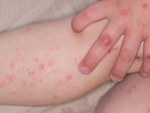 Số ca mắc tay chân miệng tiếp tục tăng