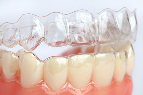 Đeo hàm duy trì giúp giữ kết quả niềng răng được ổn định. Đeo hàm duy trì giúp giữ kết quả niềng răng được ổn định.