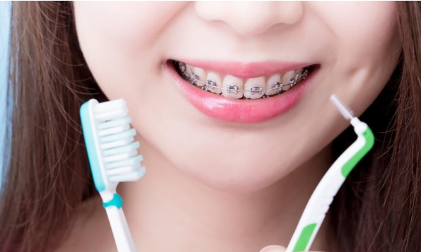 Vệ sinh răng miệng kỹ càng trong và sau khi niềng.