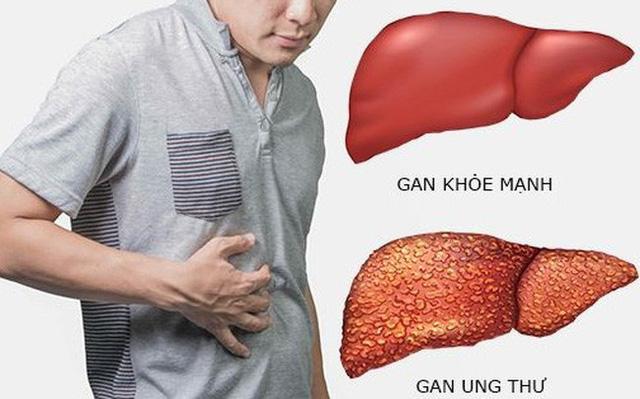 6 loại ung thư đặc biệt thích nhắm vào nam giới: Quý ông không thể không để tâm, kẻo bị đoạt mạng bất thình lình  - Ảnh 3.