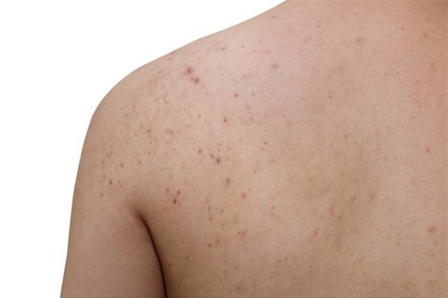 Bí quyết hết mụn ở lưng khiến bạn bất ngờ