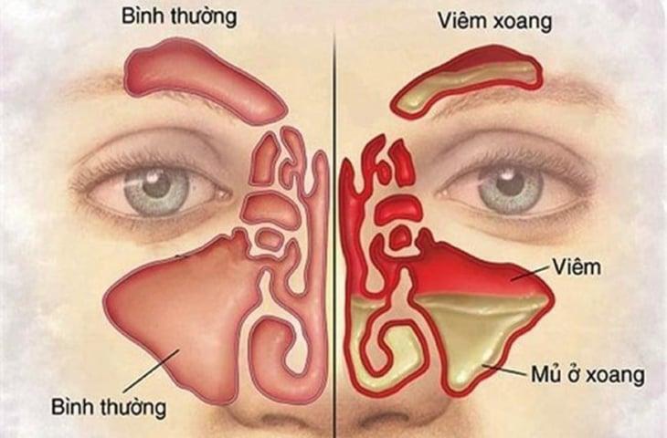 viem-xoang-01