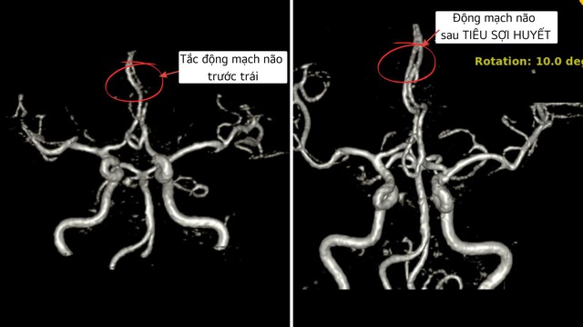 Cứu bệnh nhân đột quỵ thoát liệt người bằng phương pháp Tiêu sợi huyết- Ảnh 3.